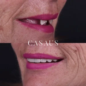 protesis sobre implantes casaus el prat de llobregat (3)