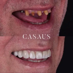 protesis sobre implantes casaus el prat de llobregat (5)