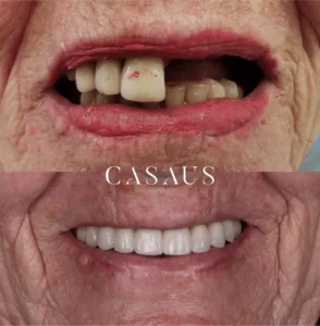 protesis sobre implantes casaus el prat de llobregat (6)