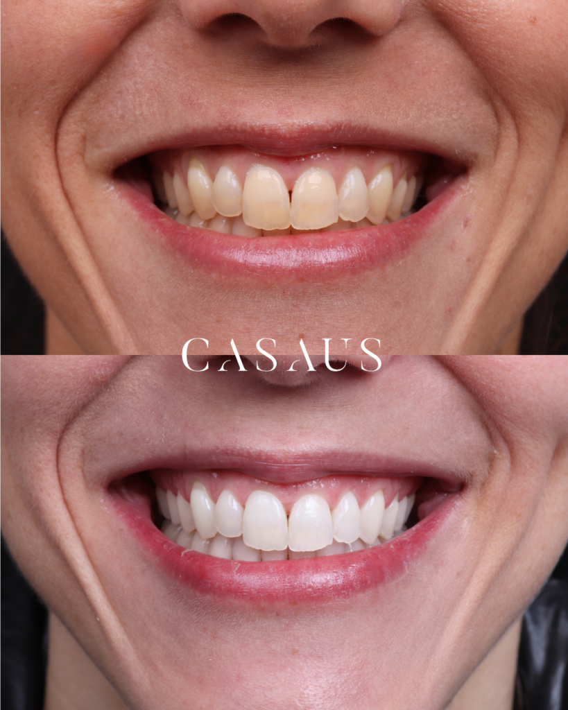 Blanqueamiento Dental Antes y después Clinica Dental Casaus en el Prat (Barcelona)