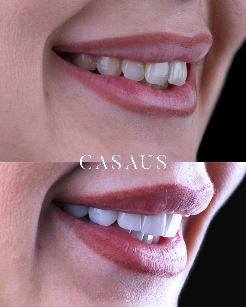 Carillas dentales Antes y después en El Prat (Barcelona)