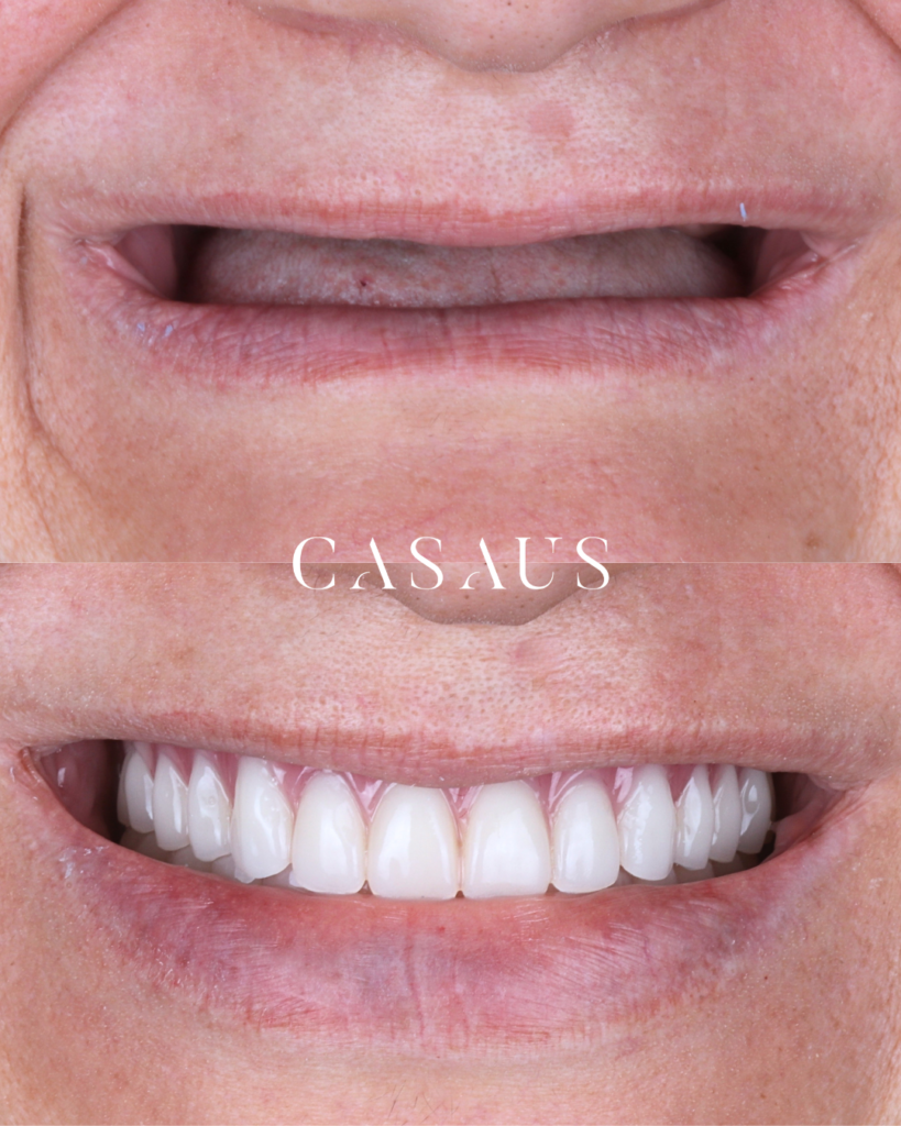Implantes Dentales Casos de éxito en el Prat Clinica Dental Casaus