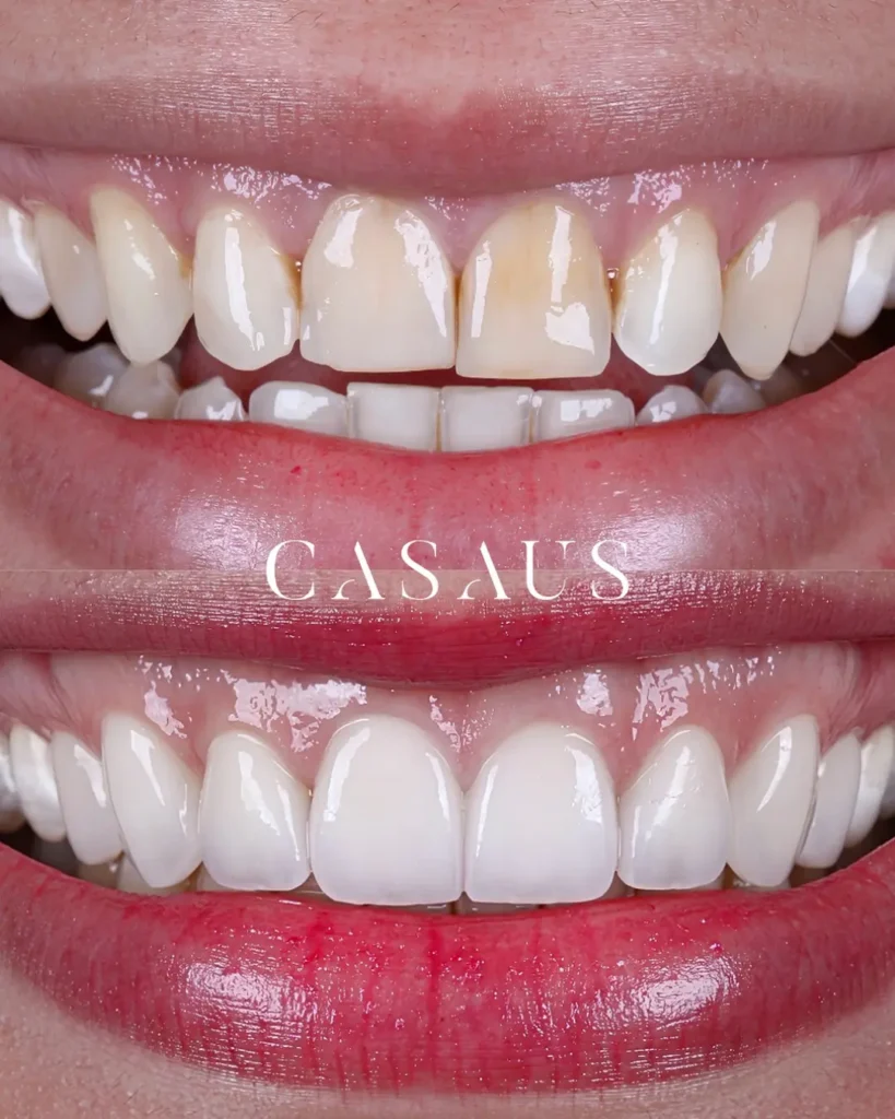 Carillas dentales antes y después Clinica Dental Casaus El Prat (Barcelona)