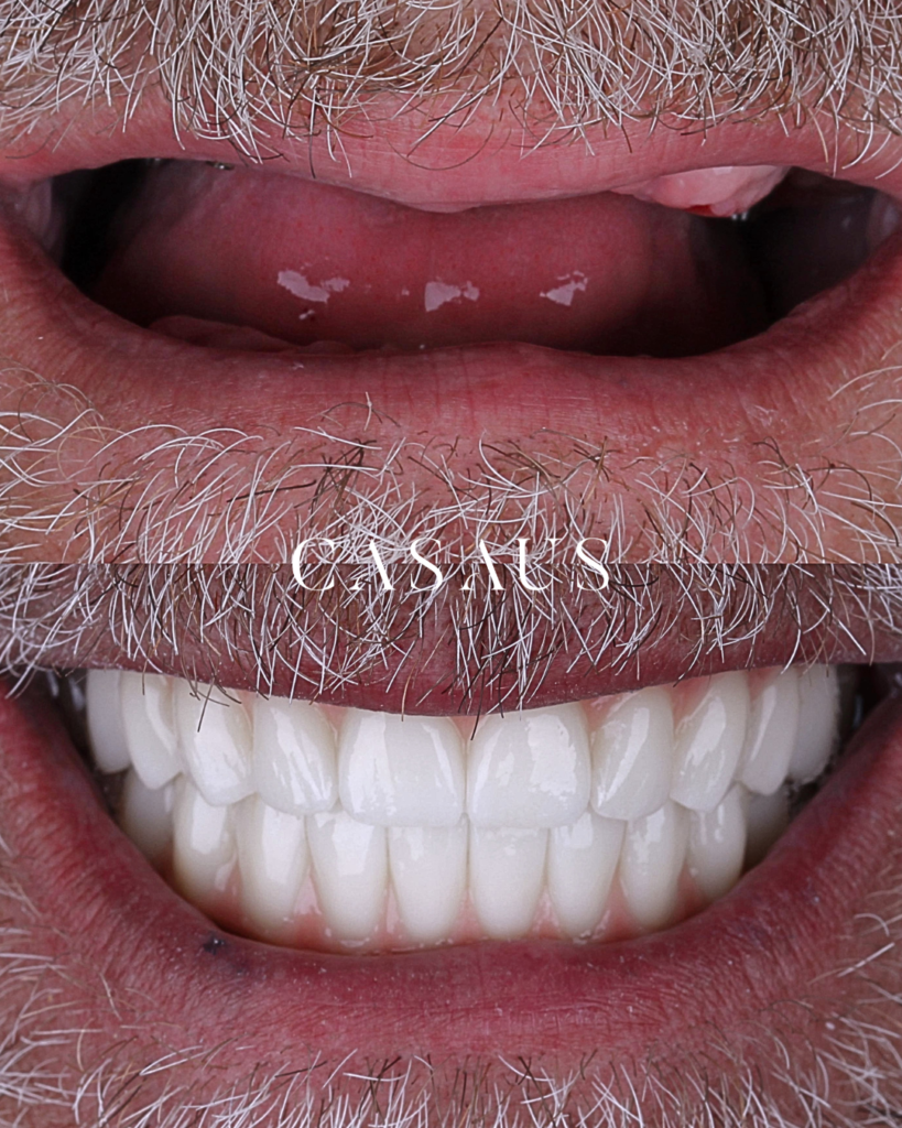 Implantes Dentales Antes y después en el Prat (Barcelona)