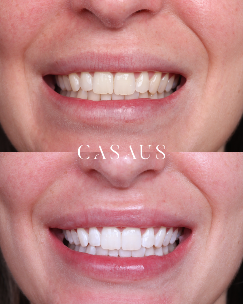 Blanqueamiento Dental Antes y después Clinica Dental Casaus en el Prat (Barcelona)