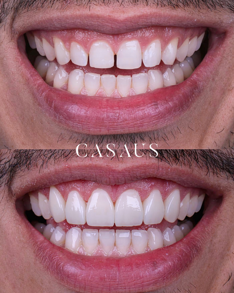 Carillas Dentales en El Prat (Barcelona) Clínica Dental Casaus)