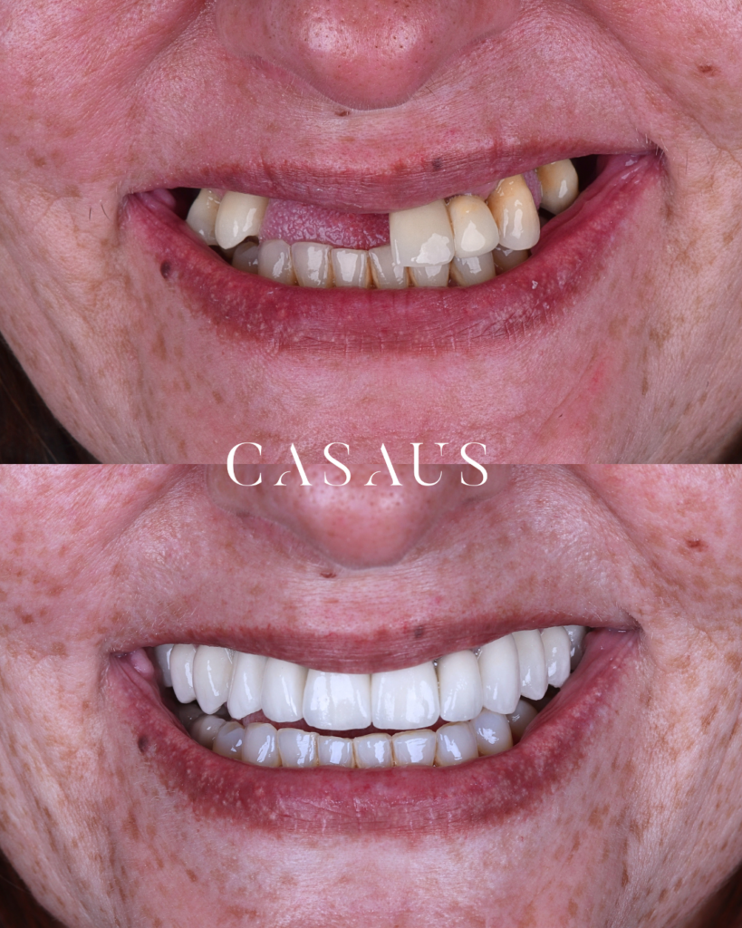 Antes y después Implantes Dentales en el Prat Clinica Casaus