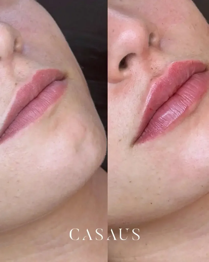 Medicina Estética Caso de éxito antes y después en Clincia Dental Casaus El Prat (Barcelona)