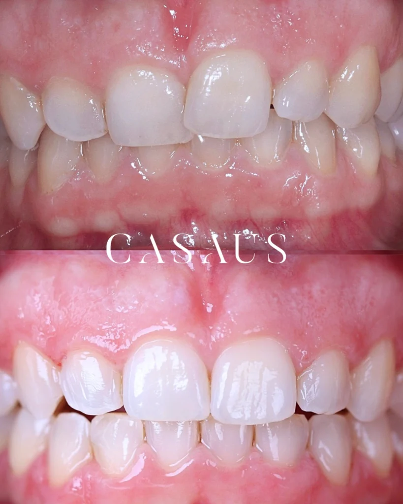 Ortodoncia 3 Antes y después en Clinica Dental Casaus El Prat