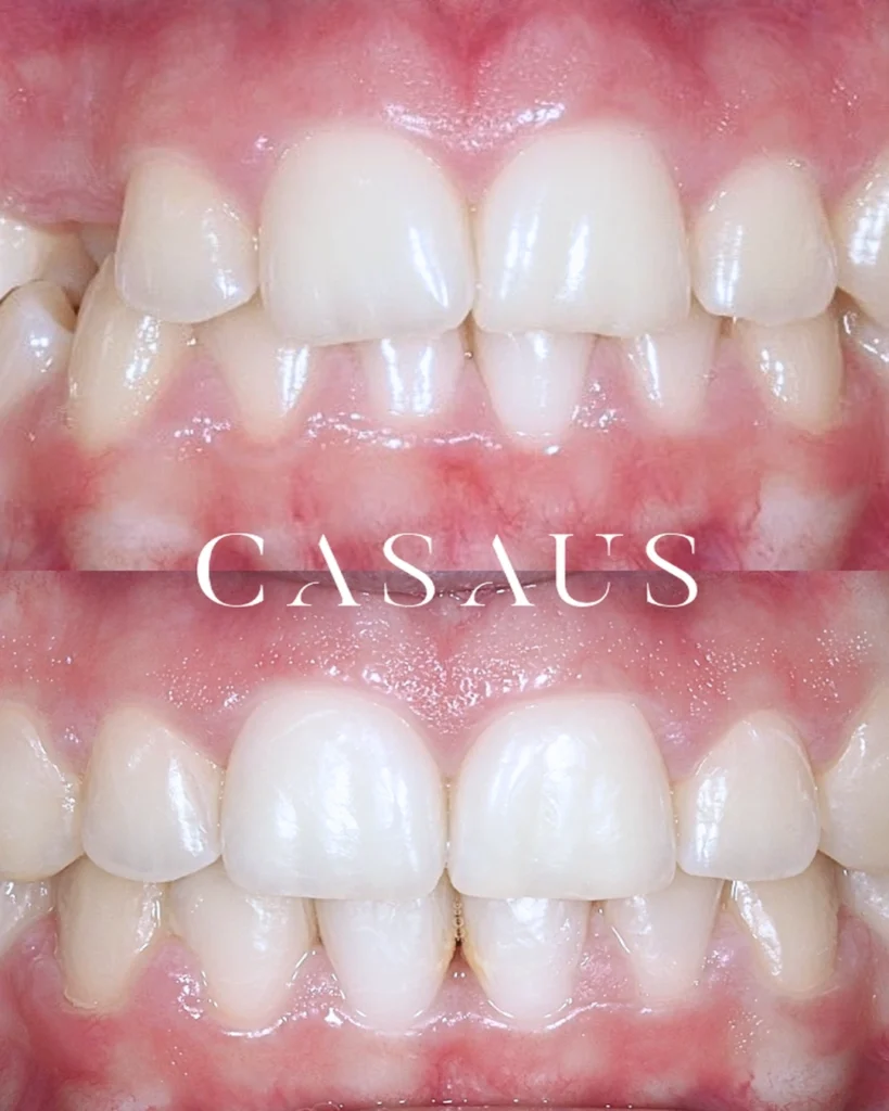 Ortodoncia Antes y después Clinica Dental Casaus