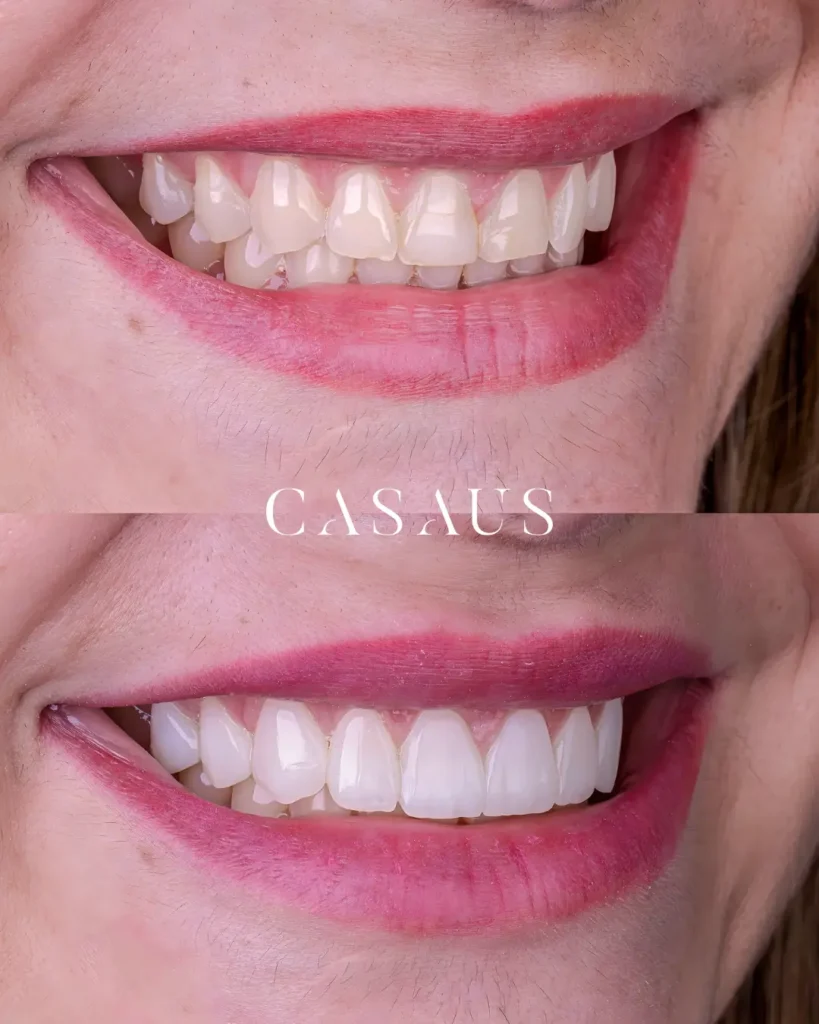 Casos de éxito antes y después Carillas Dentales en el Prat Clincia Dental Casaus