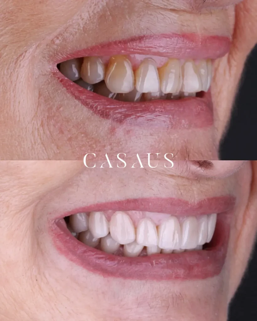 Carillas dentales Antes y después en el Prat Clincia Dental Casaus