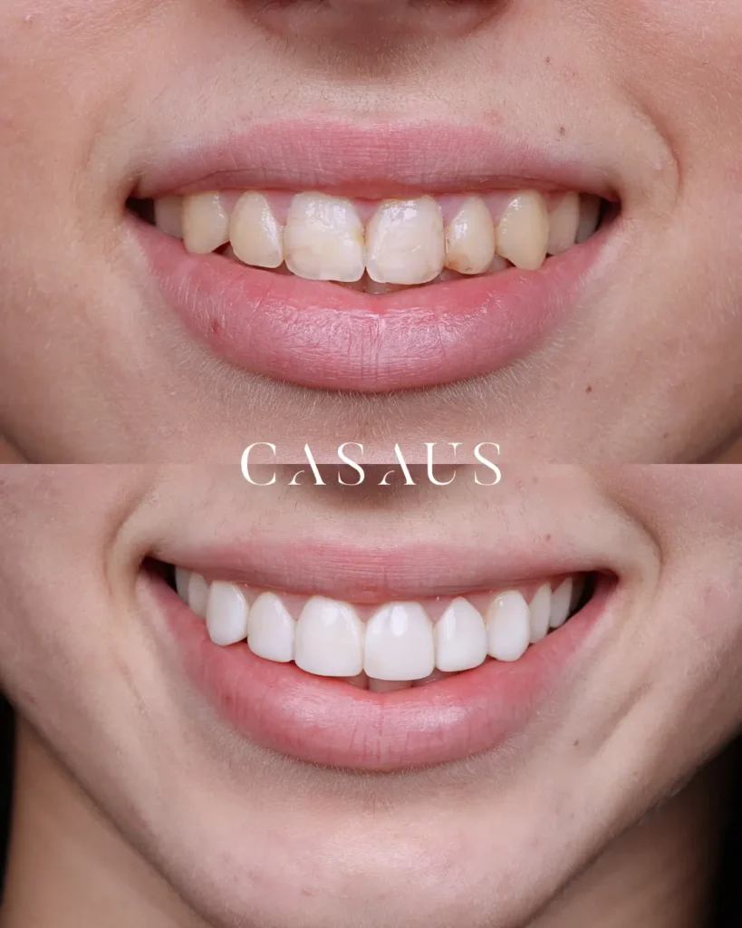 Casos de éxito carillas dentales en el Prat Clincia Dental Casaus